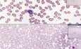 Blood - Acute Leukemia