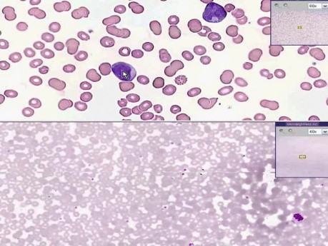 Blood - Acute Leukemia