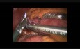 Roux en Y Gastric Bypass with Double Loop Technique