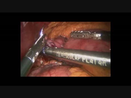 Roux en Y Gastric Bypass with Double Loop Technique