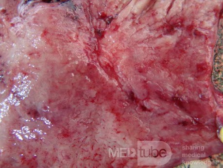 Small Gastric Adenocarcinoma of the Diffuse Ring Cell (10 of 19)