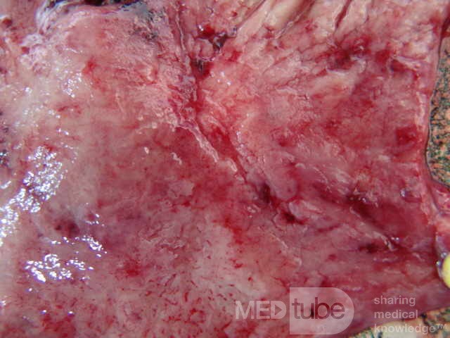Small Gastric Adenocarcinoma of the Diffuse Ring Cell (10 of 19)