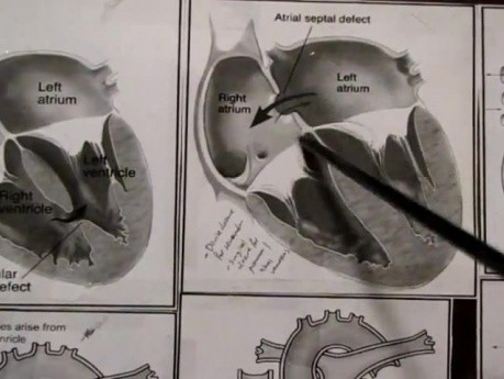 Congenital Heart Defects and Fetal CV - Lecture - 2/4