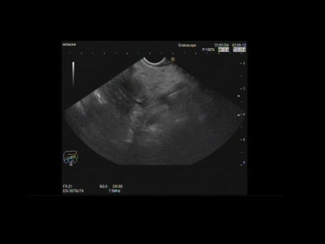 Endoscopic Ultrasound Large Pancreatic Mass