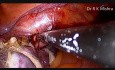 Laparoscopic Hysterectomy for Large Uterus