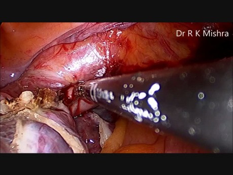 Laparoscopic Hysterectomy for Large Uterus