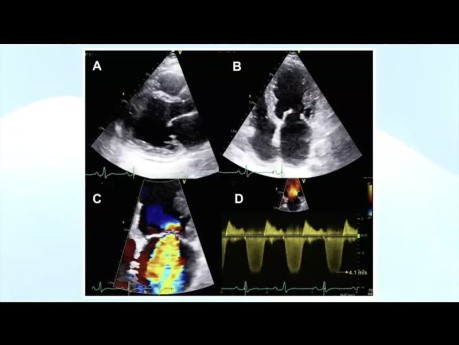 Echocardiographic Assessment of Rheumatic Heart Disease