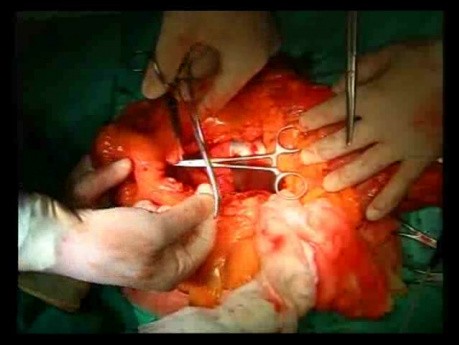 Open Right Hemicolectomy – Technical Principles - Operation No 1B - Part 3