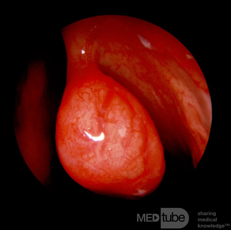 Epistaxis Originating From Middle Turbinate