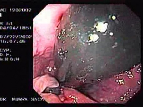Internal Hemorrhoids (2 of 2)