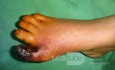 Dry gangrene great toe - ischemia 