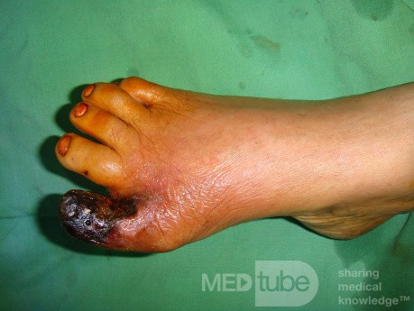Dry gangrene great toe - ischemia 