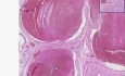 Organizing thrombi - Histopathology of prostate, blood vessels
