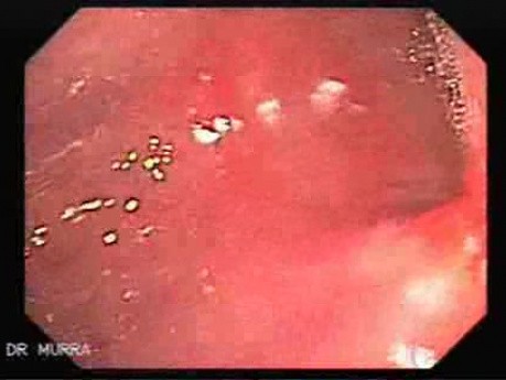 Adenocarcinoma of the Antrum (3 of 3)