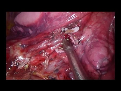 Uniportal VATS Left Anatomic Anterobasal Segmentectomy S8 (Live Surgery to Milan during the EACTS)