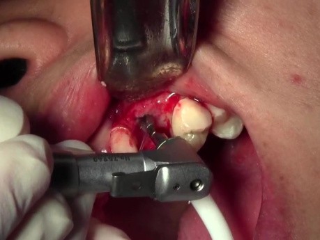 Implant Surgery, #11 Site - ID Screwplant System, Mineross Regenerated Bone