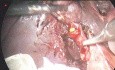Dealing with Cystic Duct Stones Needs a Patient Surgeon
