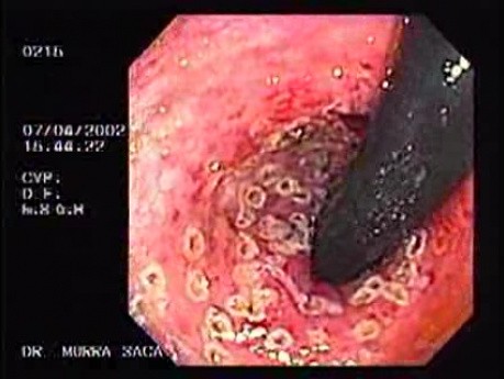 Post-Radiation Colitis (4 of 4)