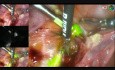 SLNB Procedure in Endometrial Cancer