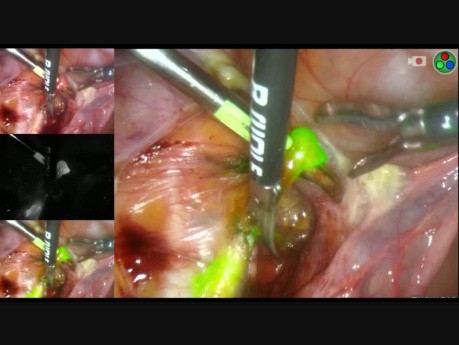 SLNB Procedure in Endometrial Cancer