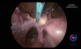 vNOTES Hysterectomy