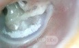 Tympanosclerosis