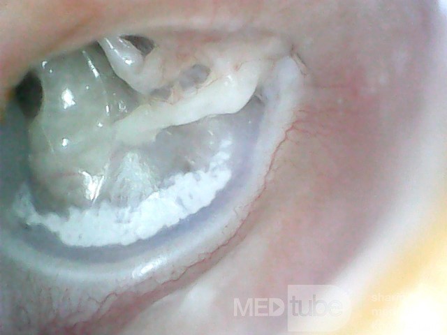 Tympanosclerosis