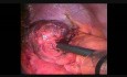 Gastric Necrosis in Diaphragmatic Hernia in a Patient with Gastric Band