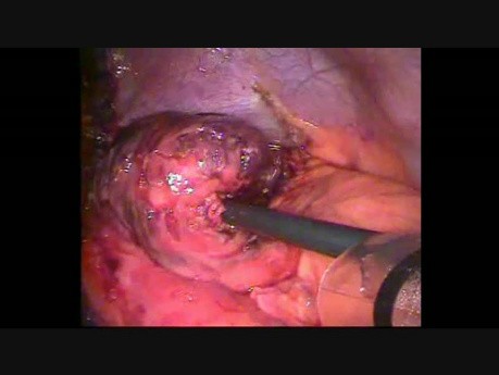 Gastric Necrosis in Diaphragmatic Hernia in a Patient with Gastric Band