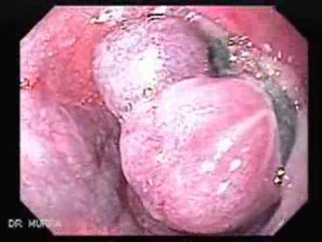Esophageal Variceal Bleeding - Varices After Ligation