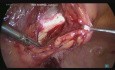 TLH followed by Pectopexy for Apical Prolapse (part 2)
