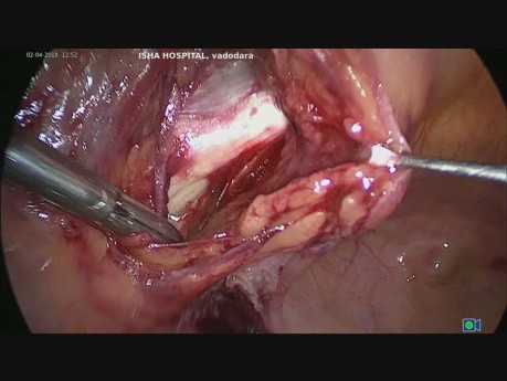 TLH followed by Pectopexy for Apical Prolapse (part 2)