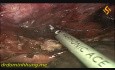 Thoraco-Laparoscopic Esophagectomy in Prone Position with Total Mediastinal Lymphadectomy