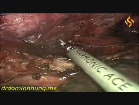 Thoraco-Laparoscopic Esophagectomy in Prone Position with Total Mediastinal Lymphadectomy