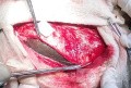 Acute Spontaneous Subdural Hemorrhage in the Subdural Space