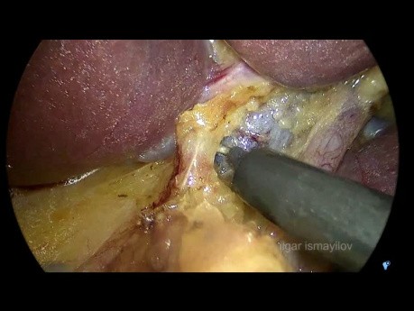Laparoscopic Total Gastrectomy + D 2 LND