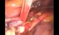 Controle Of Uterine Artery Bleeding During Hysterectomy