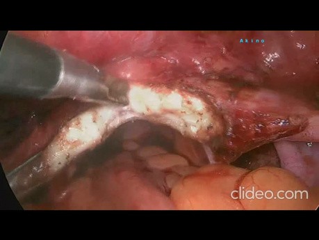 Peritoneal Pull Through Technique of Laparoscopic Vaginoplasty in Absent Uterus