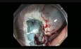 Colonoscopy Gone Awry - Asc col emr bleeding clip - Case 1B