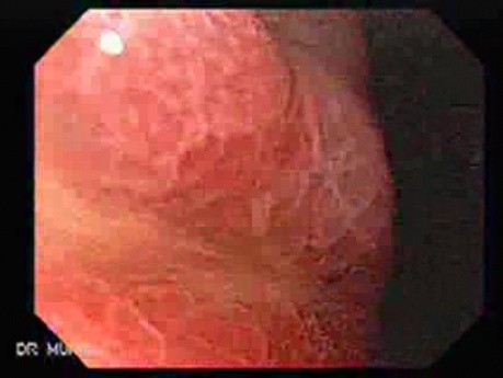 Multiple Gastric Ulcers - Endoscopy (3 of 10)