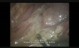 Laparoscopic Treatment of a Jejunal Perforated Diverticulum