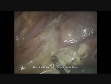 Laparoscopic Treatment of a Jejunal Perforated Diverticulum