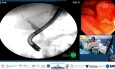 Wire Patency is not Catheter Patency