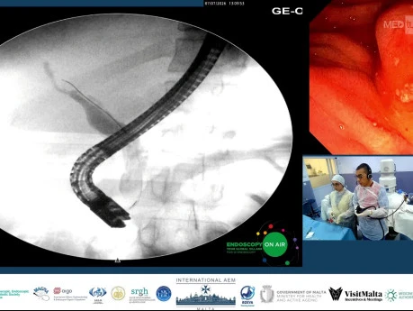Wire Patency is not Catheter Patency