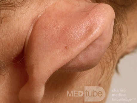 Hematoma of the Pinna