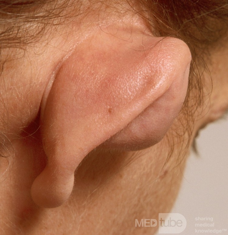 Hematoma of the Pinna