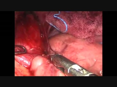 Lap Heller Cardiomyotomy
