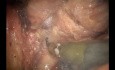 Robotic Abdominoperineal Resection with Intraabdominal Levator Transection