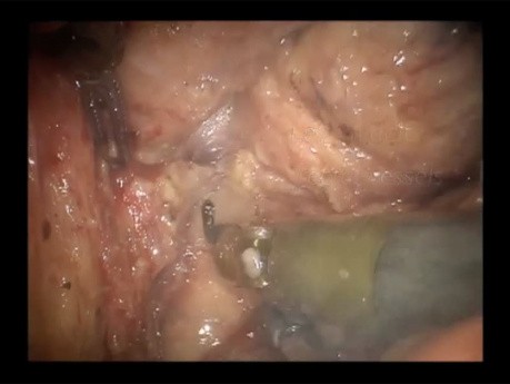 Robotic Abdominoperineal Resection with Intraabdominal Levator Transection