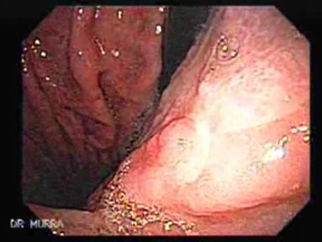 Non-Hodking Lymphoma - Closer Look at the Mucosa